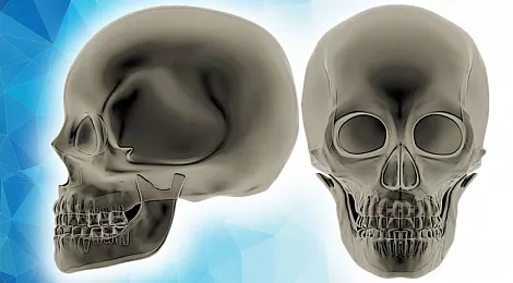 slm-zygomatic-defect-case