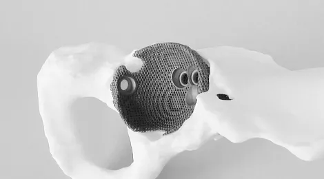 materialise-3d-printing-surgery-cases