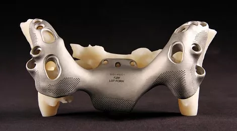 3d-systems-implants-case